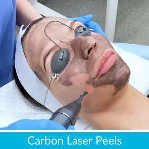 Carbon Laser peels