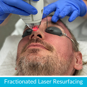 Fractionated Laser Resurfacing