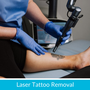 Laser Tatoo removal