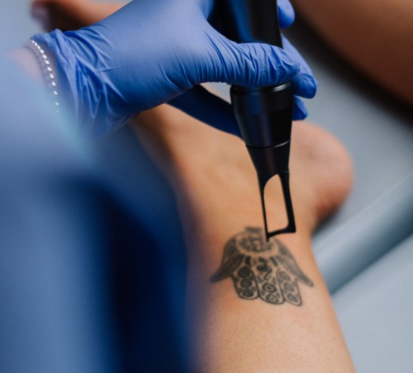 FREE Laser Tattoo Removal | Aspire Training Clinic